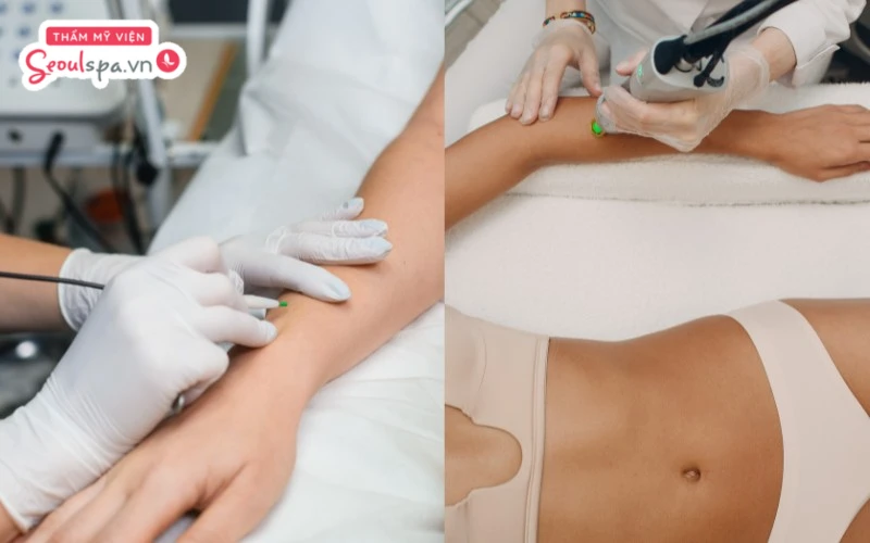 Điện phân và Laser là hai công nghệ triệt lông hiện đại giúp đem lại hiệu quả loại bỏ lông lâu dài theo thời gian