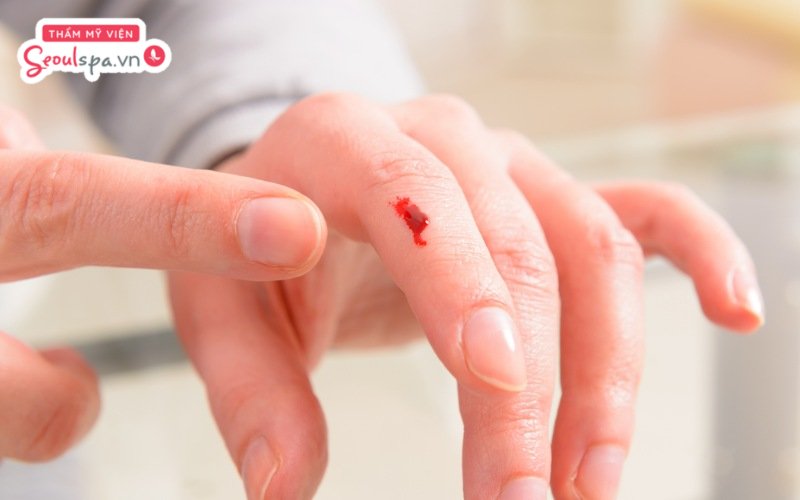 Tránh để bản thân chảy máu vào ngày mùng 1 vì được cho là vận xui và điềm báo không may mắn