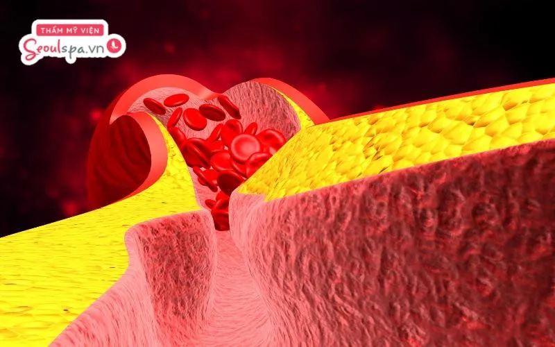 Người có cơ chế đông máu kém hoặc có bệnh lý rối loạn đông máu không nên thực hiện phun chân mày