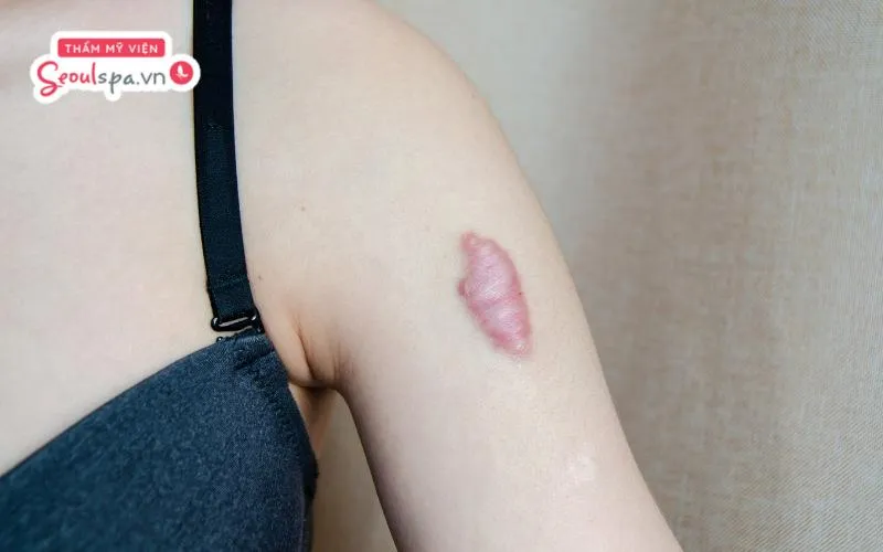 Người có cơ địa sẹo lồi không nên làm chân mày vì dễ kích thích tổn thương hở trên da tăng sinh collagen quá mức và hình thành sẹo