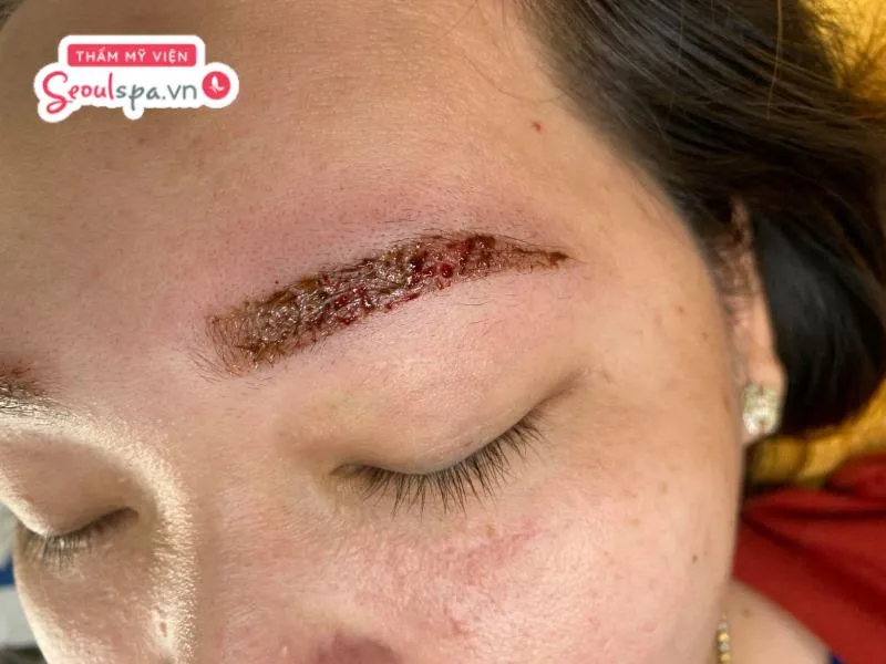 Dị ứng mực xăm là một trong những tình trạng viêm nhiễm khi da tiếp xúc với hóa chất có trong mực xăm