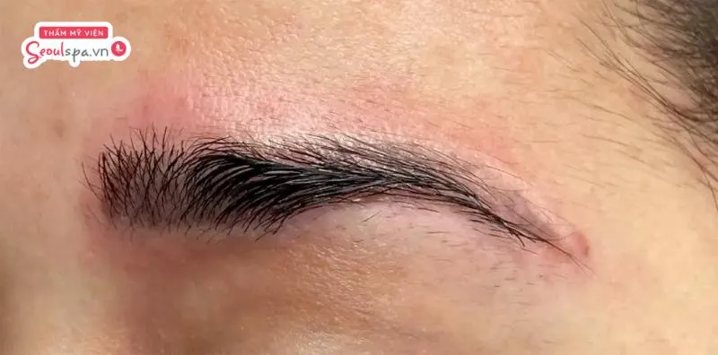 Người có cơ địa da nhạy cảm thường dễ tiềm ẩn nguy cơ sưng tấy và nổi mụn nước ngoài ý muốn