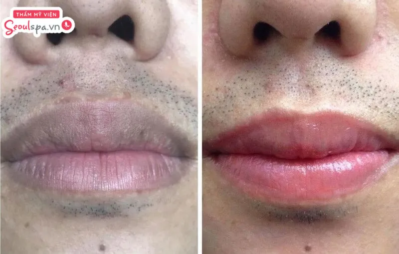 Sau phun môi khắc phục hiệu quả tình trạng môi thâm ở nam giới