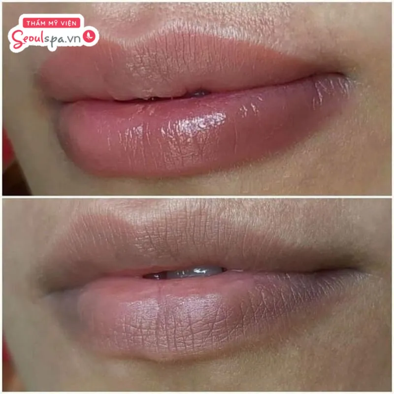 Tình trạng thâm viền môi, màu môi nhợt nhạt được cải thiện đáng kể
