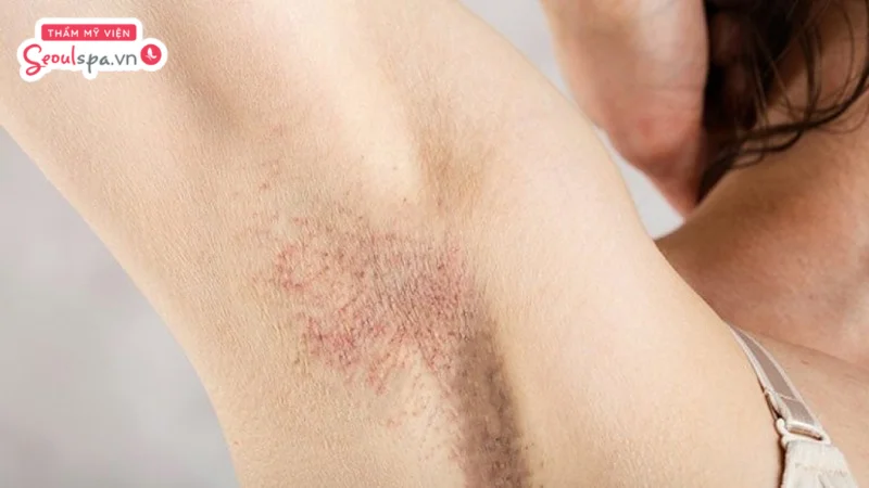 Thực hiện cạo lông sai cách ở tuổi dậy thì có thể khiến vùng da dưới cánh tay dễ kích ứng, nổi mẩn đỏ và gia tăng nguy cơ viêm nhiễm