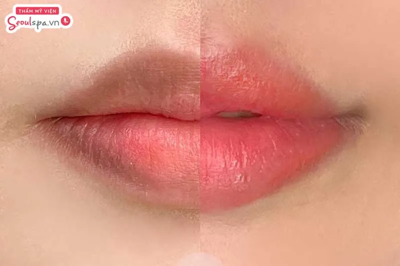 Khử thâm môi bằng laser phù hợp với nhiều đối tượng, nhất là những người có đôi môi thâm xỉn