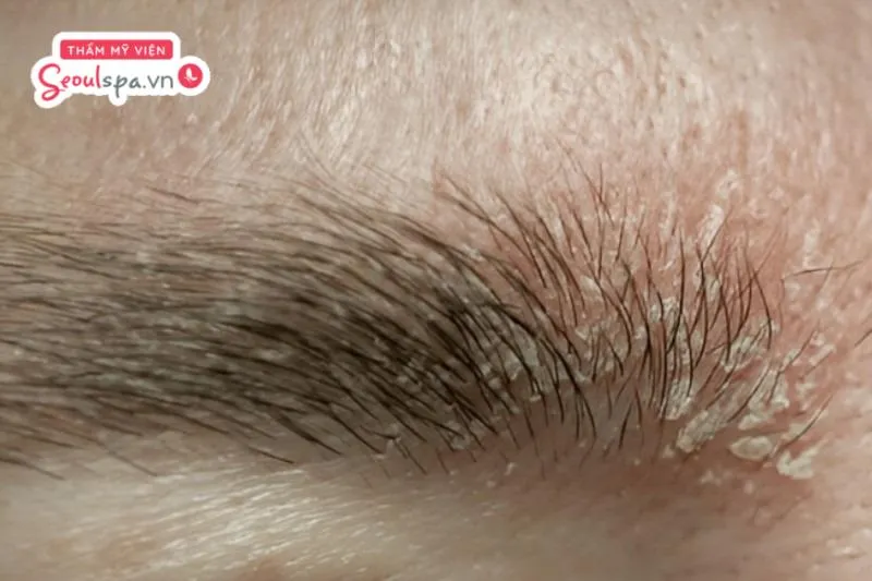 Viêm tiết bã nhờn, chàm và vảy nếu là một trong những bệnh lý da liễu khiến chân mày dễ rụng và khó mọc lại