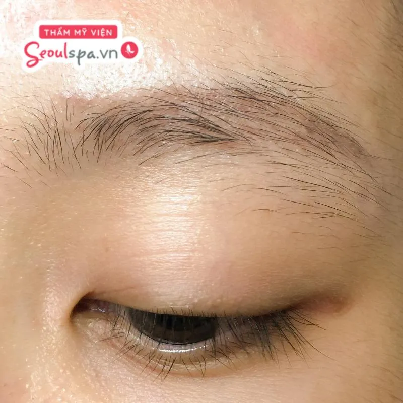 Rụng lông mày có thể mọc lại theo chu kỳ phát triển tự nhiên của lông nhưng có thể mọc lại chậm và không đạt được hiệu quả thẩm mỹ cao