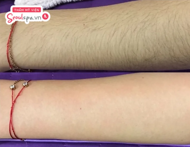 Hình ảnh trước và sau khi kết thúc liệu trình triệt lông với hiệu quả đem lại khác biệt rõ rệt