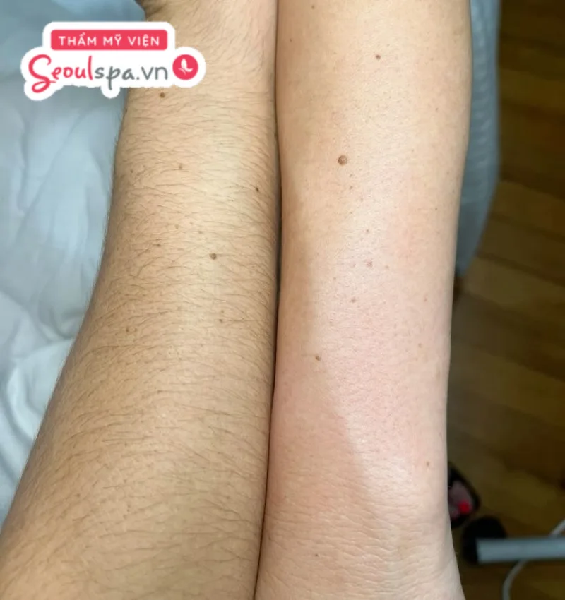 Lông có dấu hiệu mọc thưa thớt và mỏng dần hơn sau khi kết thúc quy trình triệt lông 1/2 tay