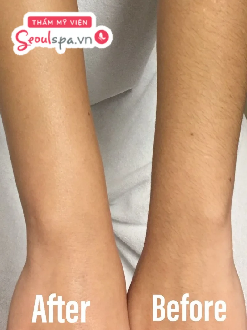 Hình ảnh trước và sau khi triệt lông tay tại với mật độ lông cải thiện rõ rệt sau quá trình thực hiện