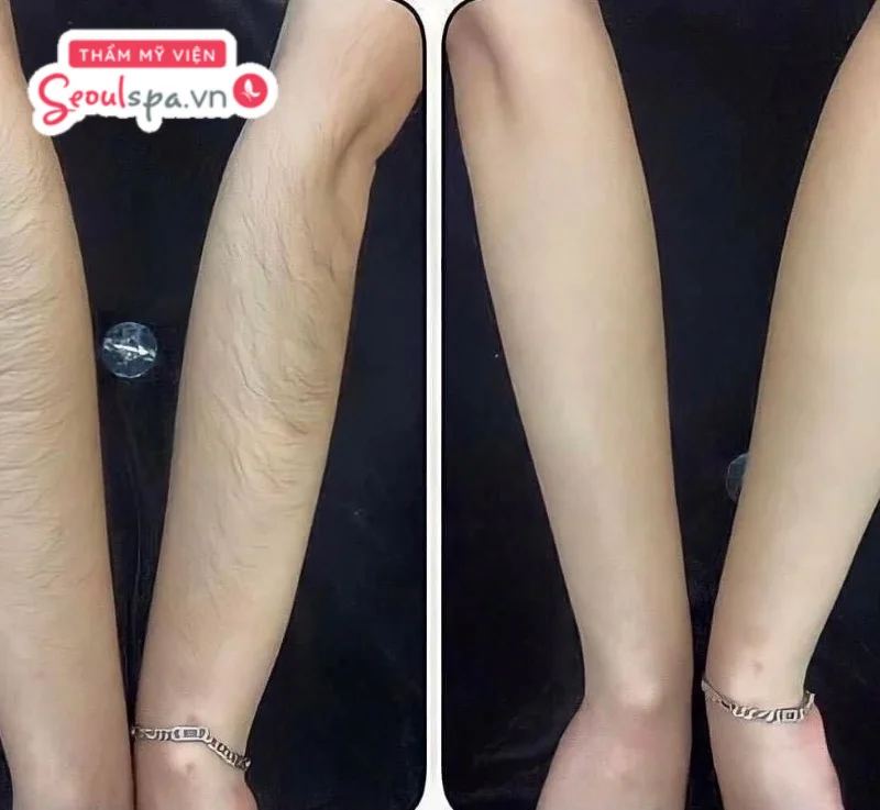 Tình trạng lông mọc rậm rạp và mất thẩm mỹ đã được khắc phục hiệu quả khi triệt lông 1/2 tay