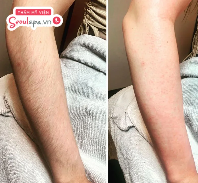 Khách hàng có cơ địa da nhạy cảm với tình trạng da sưng đỏ nhẹ sau khi kết thúc quy trình triệt lông