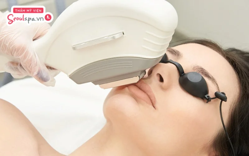 Điểm hạn chế công nghệ IPL là không phù hợp với vùng da mỏng và nhạy cảm ở khu vực mặt hoặc ria mép quanh miệng