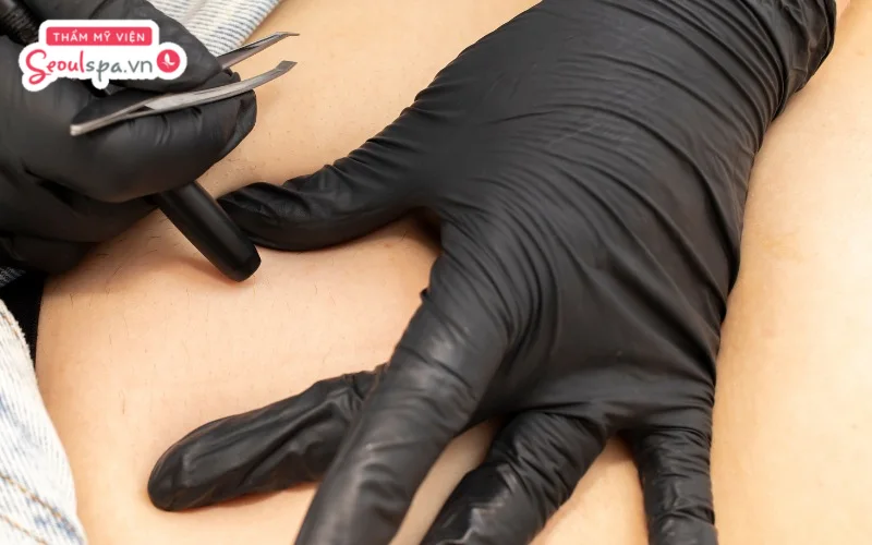 Điện phân là phương pháp triệt lông vĩnh viễn giúp phá hủy trực tiếp từng gốc nang lông và đem lại hiệu quả triệt để