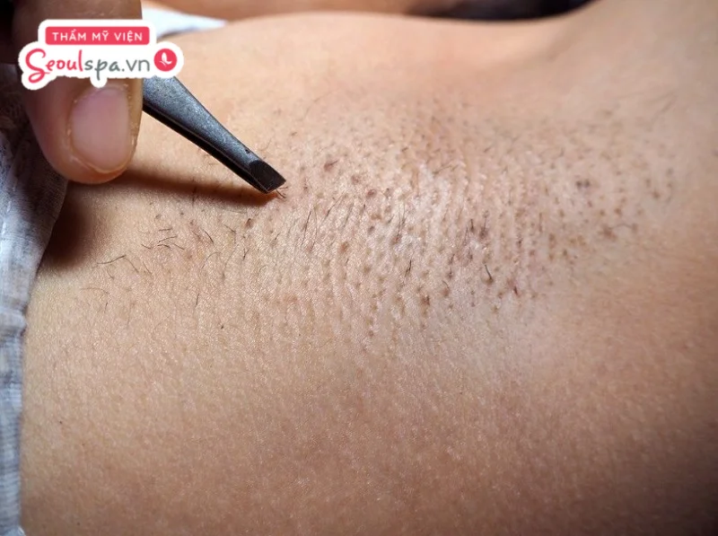 Khi áp dụng cách nhổ lông nách không đau tại nhà, bạn cần chú ý thực hiện nhổ từng sợi nhẹ nhàng theo chiều lông mọc