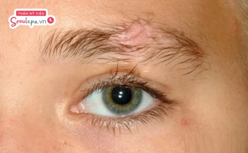 Người có sẹo vùng chân mày là đối tượng không nên phun xăm chân mày vì dễ khiến tình trạng sẹo trở nên nghiêm trọng hơn