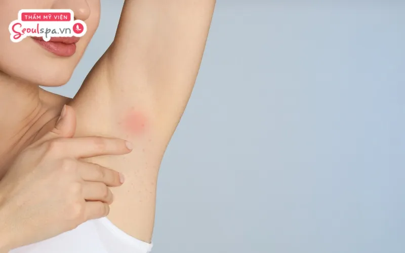 Tẩy lông nách bị rát được cho là tiềm ẩn nhiều nguy cơ viêm nhiễm, kích ứng và ảnh hưởng hàng rào bảo vệ da