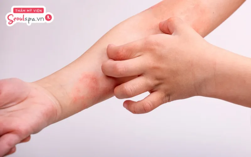 Người có các vấn đề da liên quan viêm da tiếp xúc được cho là nguyên nhân khiến da tiềm ẩn nguy cơ đỏ rát sau triệt lông