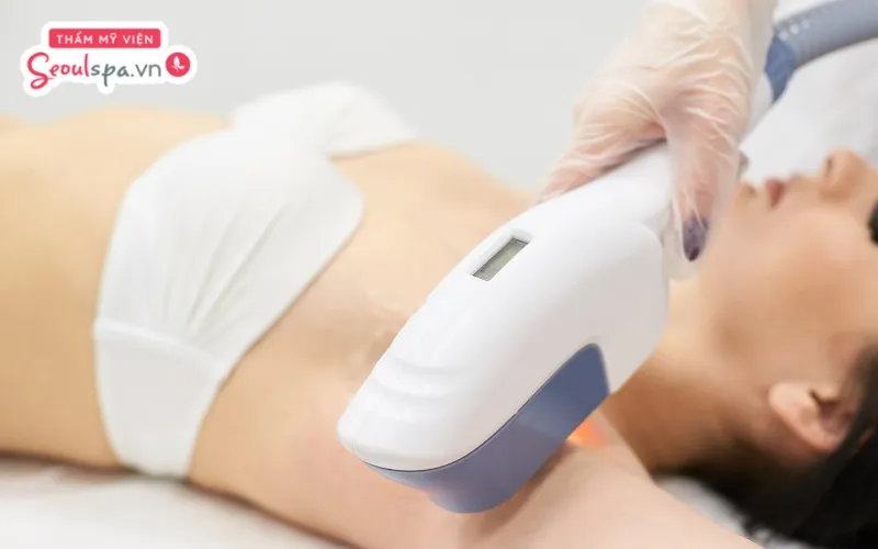 Có thể sử dụng lại lăn khử mùi sau 48 giờ nếu thực hiện liệu pháp triệt lông bằng công nghệ cao