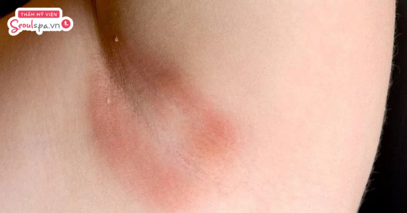 Vùng da dưới cánh tay có thể tiềm ẩn rủi ro bỏng rát nếu điều chỉnh bước sóng năng lượng không phù hợp