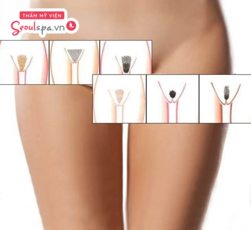 Tạo hình bikini gọn gàng kiểu Pháp, giọt nước hay trái tim là những kiểu giúp gia tăng tính thẩm mỹ cho vùng kín