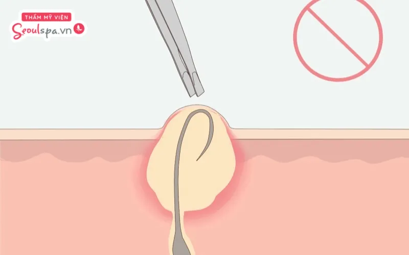 Vùng kín mọc ngược lông để lại nhiều cảm giác đau rát, khó chịu và ảnh hưởng đến đời sống sinh hoạt