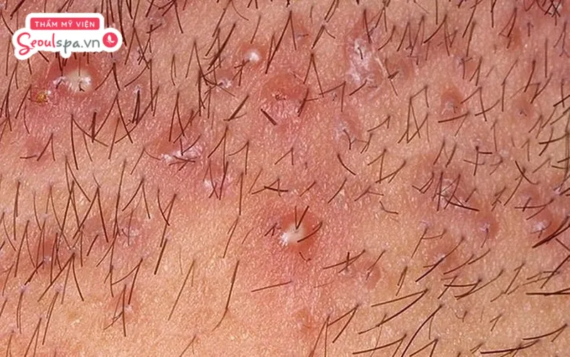 Tình trạng lông vùng kín mọc ngược thường không tiềm ẩn quá nhiều rủi ro nguy hiểm và ảnh hưởng sức khỏe