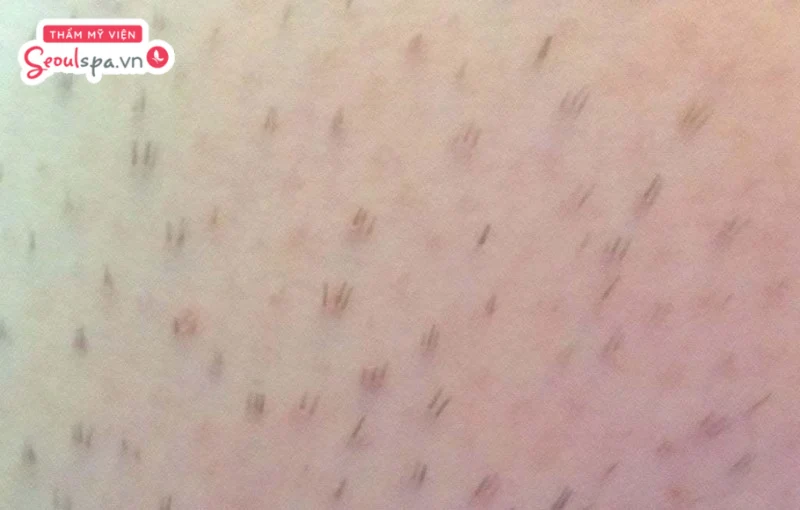 Lông nách mọc đôi là hiện tượng có 2 sợi lông cùng mọc ở một lỗ chân lông