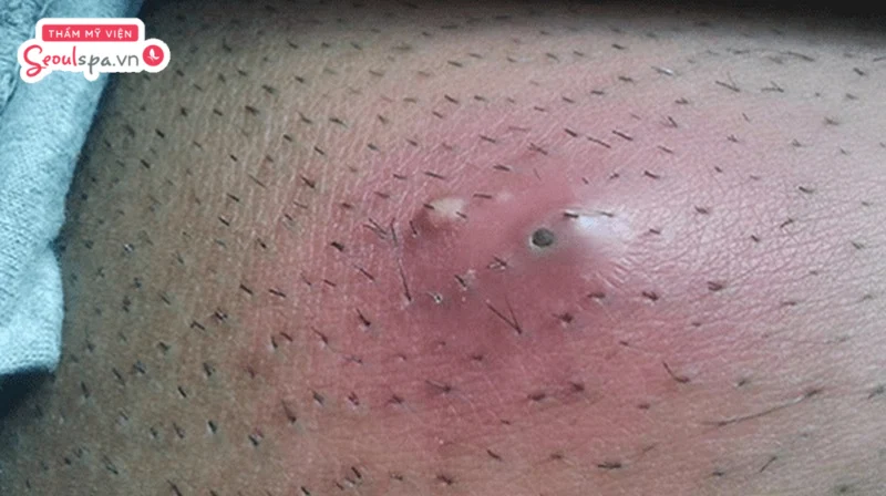 Viêm nang lông cũng là một trong những yếu tố khiến lông nách mọc đôi