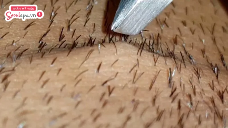 Lông nách mọc đôi có thể gia tăng nguy cơ viêm nhiễm, kích ứng và tăng tiết mùi hôi cơ thể