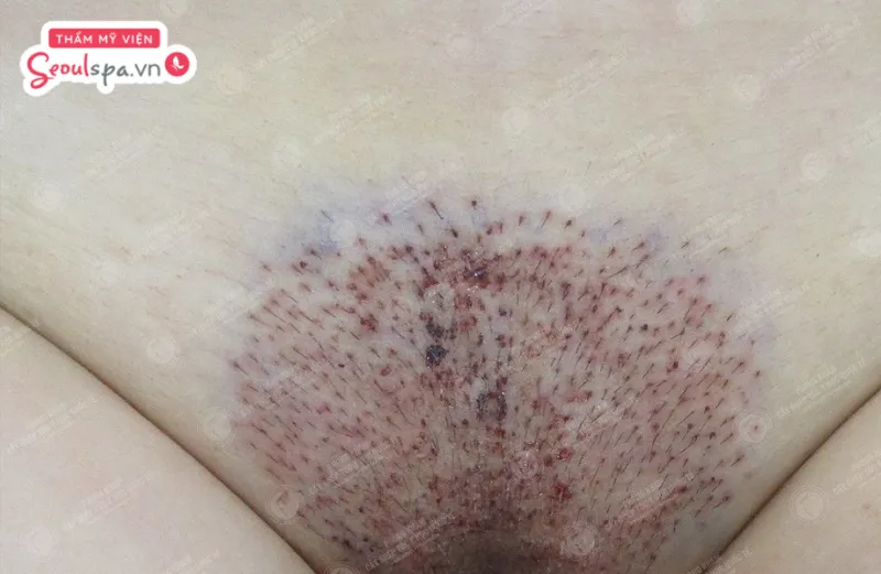 Cấy lông vùng kín hiệu quả an toàn, không xâm lấn