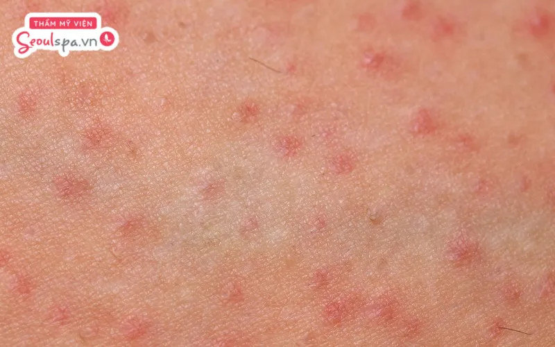 Thao tác thực hiện nhổ lông sai cách có thể khiến vùng kín dễ bị tổn thương và gia tăng nguy cơ viêm nang lông