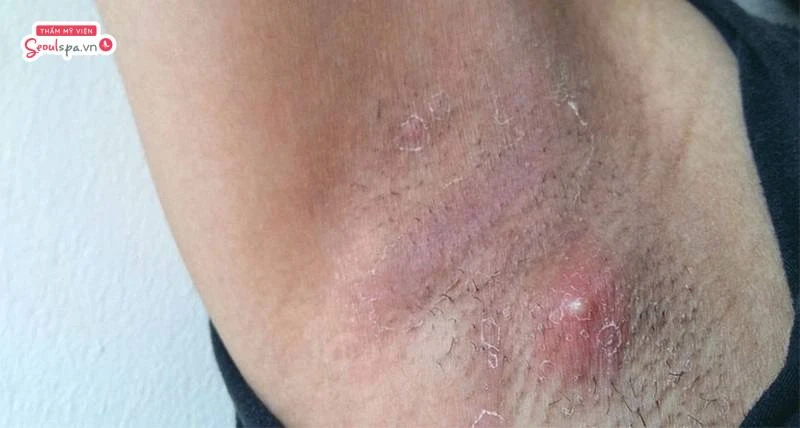 Khi nách có mụn hoặc vết thương hở thì không nên tẩy lông