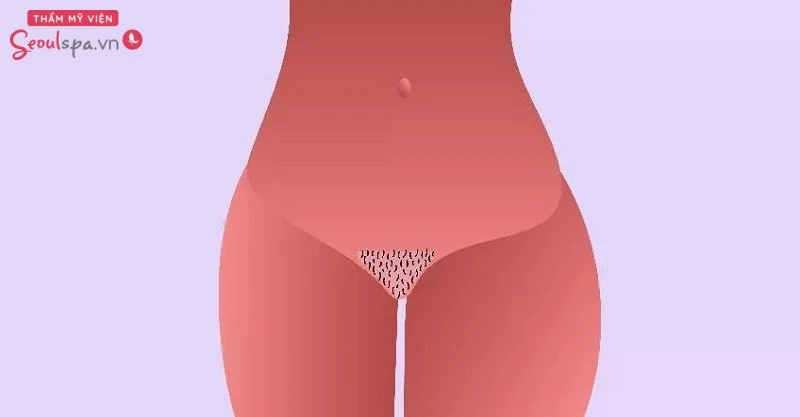 Lựa chọn triệt lông kiểu ly rượu Martini khá phổ biến hiện nay