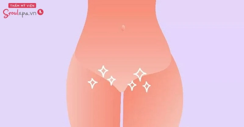 Kiểu tạo hình lông vùng kín Brazil thoáng đãng cho chị em