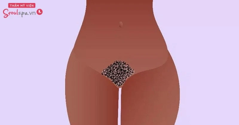 Lựa chọn tạo hình vùng kín kiểu bụi rậm ấn tượng và bảo vệ “cô bé” tốt