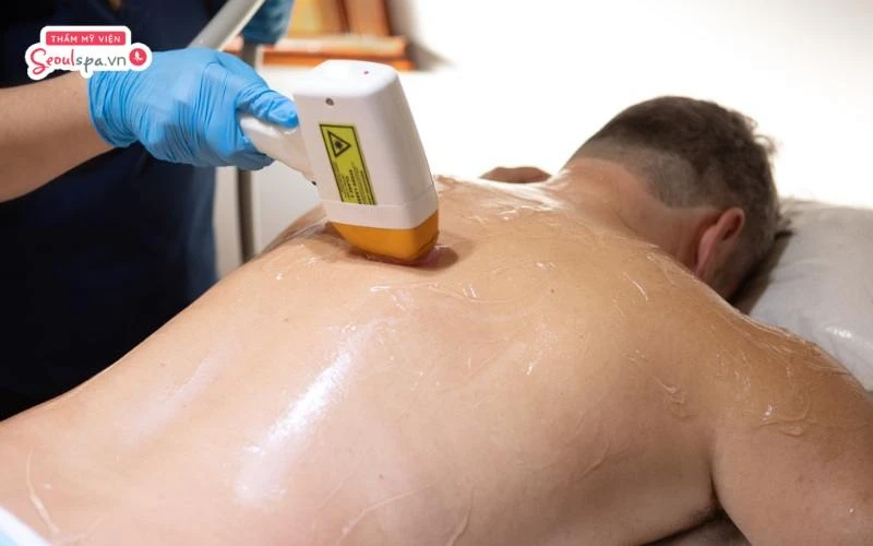 Quy trình triệt lông lưng chuẩn Y khoa giúp hạn chế nguy cơ viêm nhiễm tại thẩm mỹ viện