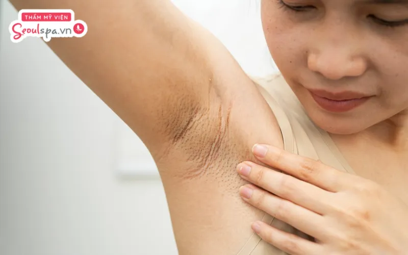 Triệt lông nách có thể góp phần giảm mùi hôi vùng nách nhưng không khử mùi hoàn toàn