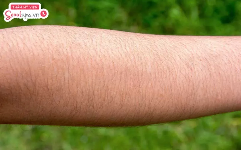 Triệt lông theo cách người Dao Đỏ thường đem lại hiệu quả rõ rệt sau 3 - 4 tuần thực hiện