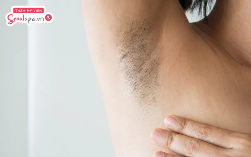 Tình trạng lông và da của từng người là yếu tố quan trọng ảnh hưởng đến triệt lông nách vĩnh viễn giá bao nhiêu
