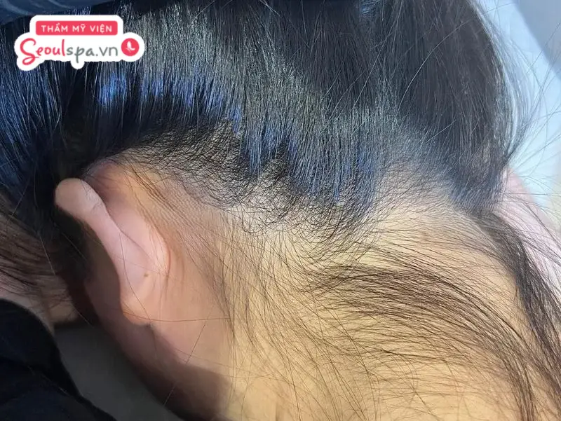 Tình trạng lông tóc mọc nhiều sau gáy có thể xuất phát bởi nhiều nguyên nhân liên quan tính di truyền, tính trạng sức khỏe