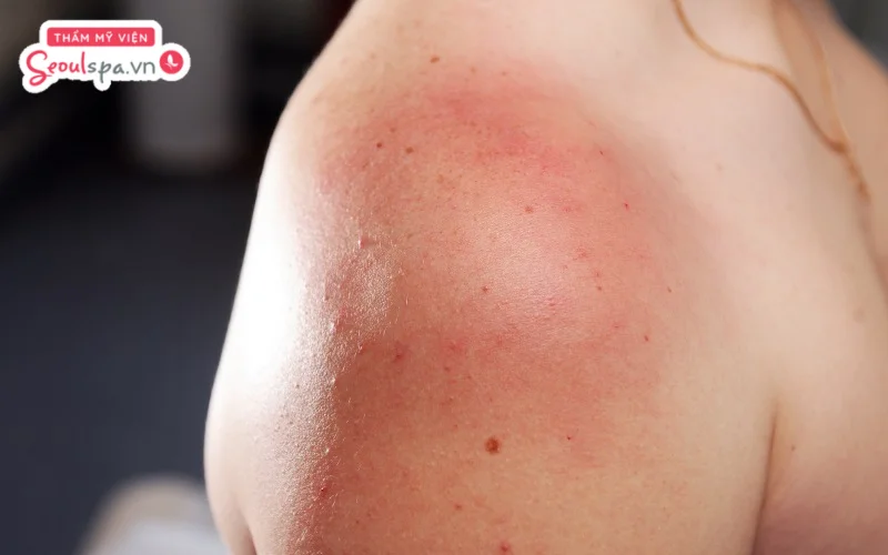Tránh triệt lông khi da đang cháy nắng, bị bỏng hoặc có dấu hiệu kích ứng trên bề mặt da