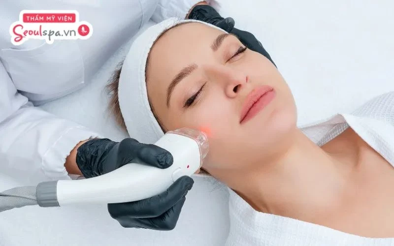 Triệt lông mặt sai cách có thể gây mụn 