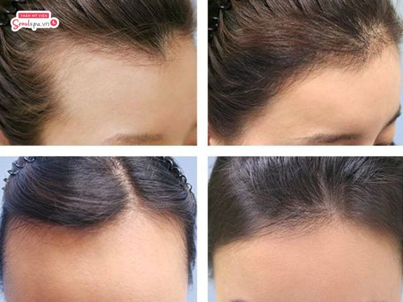 Triệt tóc trán giúp cô nàng có trán cao hài hòa và gọn gàng hơn