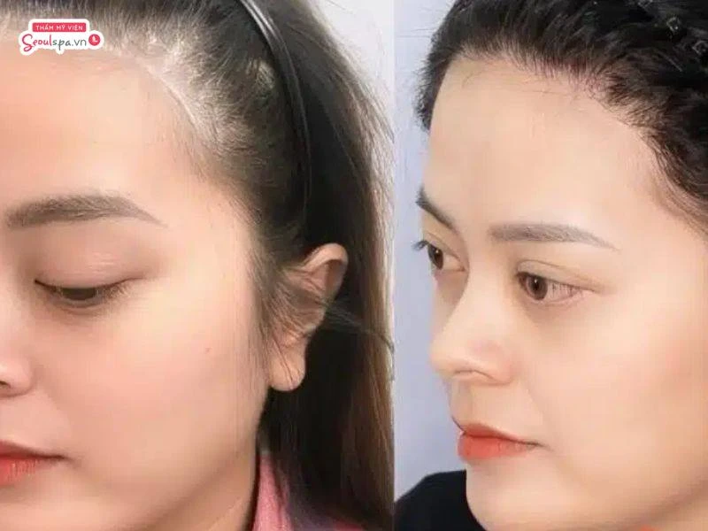 Thay đổi gương mặt sau khi triệt chân tóc trán