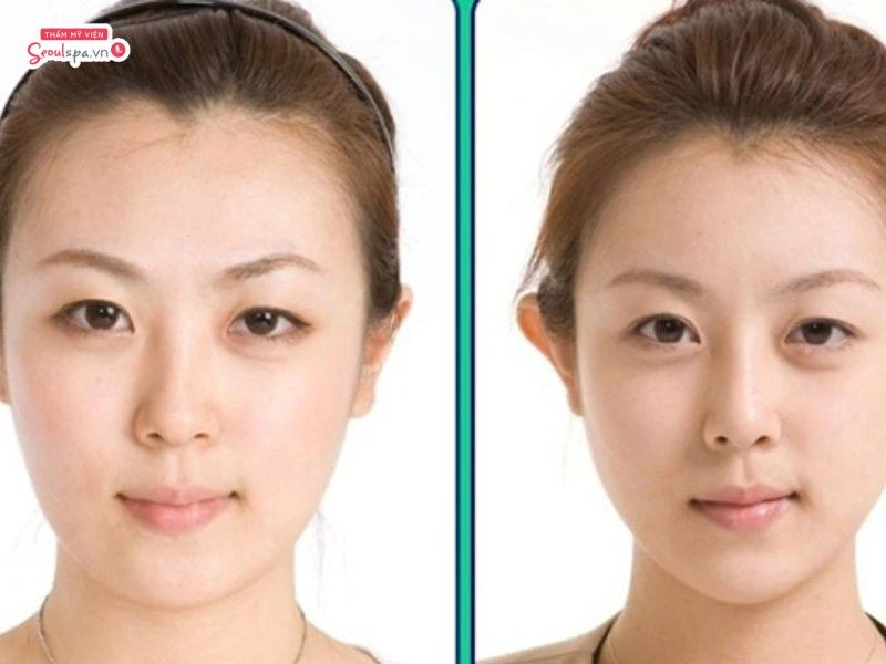 Vầng trán sáng hơn khi triệt tóc