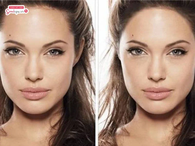 Thay đổi khi triệt chân tóc trán