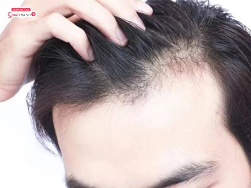 Triệt chân tóc trán giúp bạn tự tin hơn