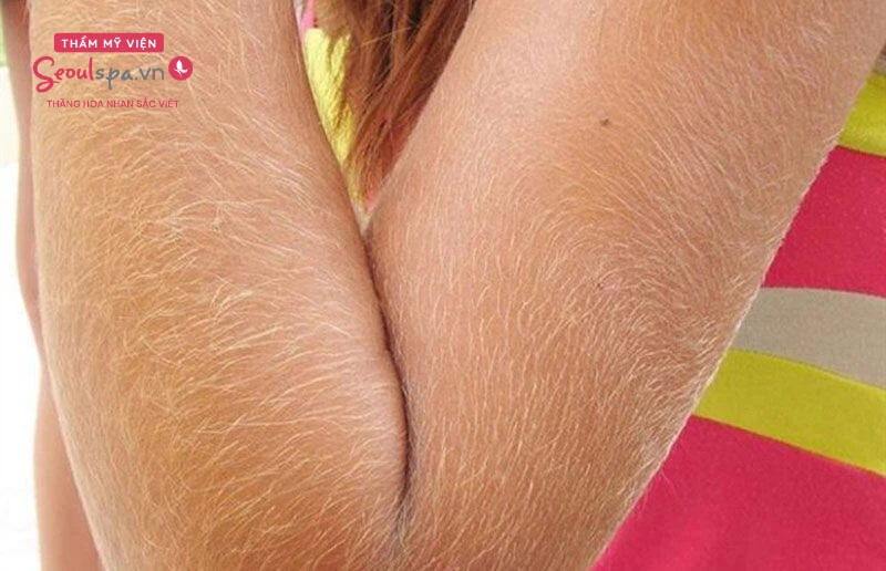 Con gái nhiều lông tay màu vàng nhạt do thiếu sắc tố melanin